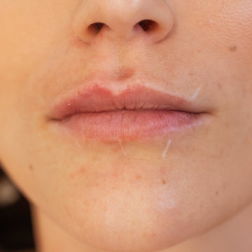 Prima del filler labbra nello studio Aleri Medicina Estetica di Milano