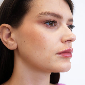Risultato dopo il trattamento di Filler Labbra allo studio Aleri Medicina Estetica di Milano
